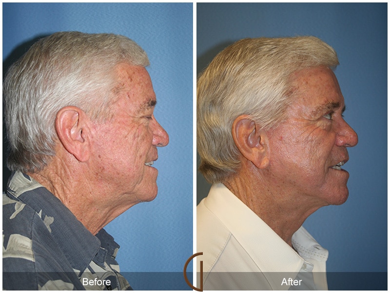 Facelift Cerritos CA Image