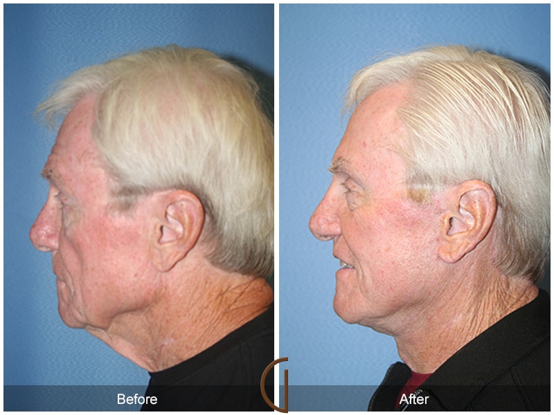 Facelift Solana Beach CA 22 Image
