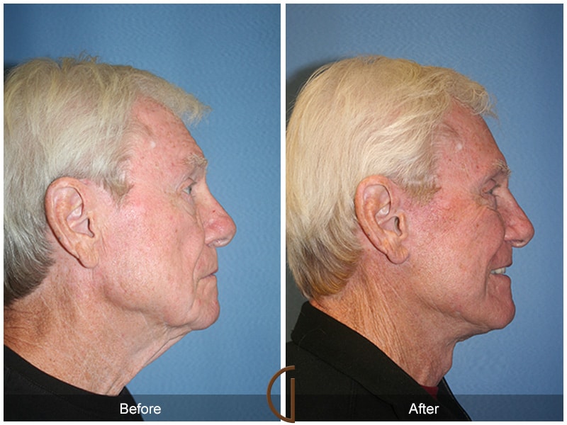 Facelift Solana Beach CA 22 Image