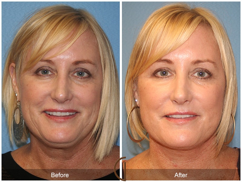 Facelift Orange County CA 31 Image