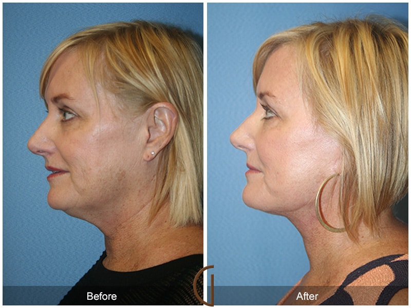 Facelift Orange County CA 31 Image