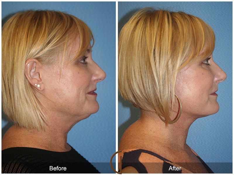 Facelift Orange County CA 31 Image