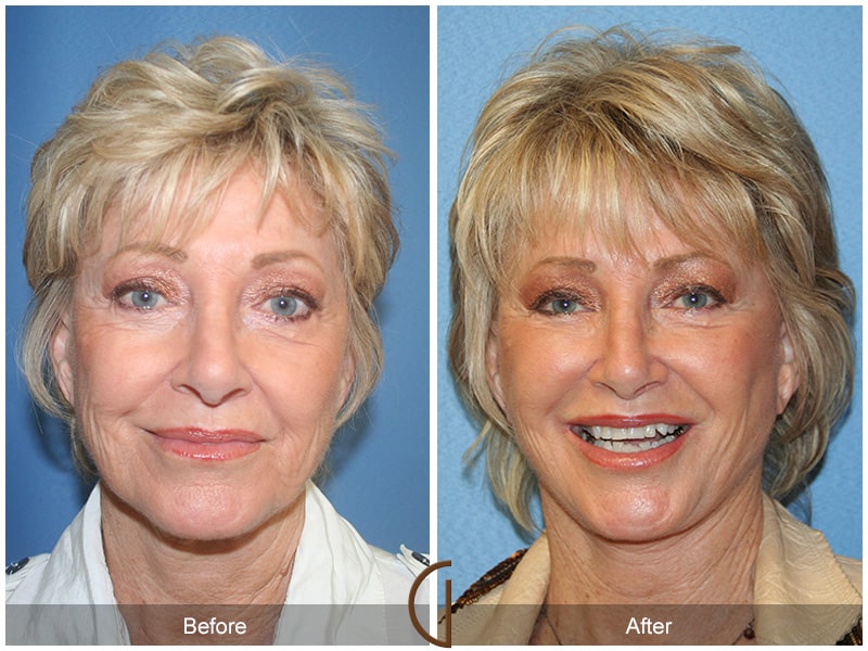 Facelift Woodcrest CA 34 Image