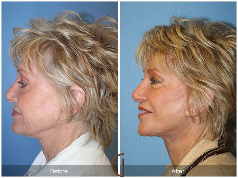 Facelift Woodcrest CA 34 Image