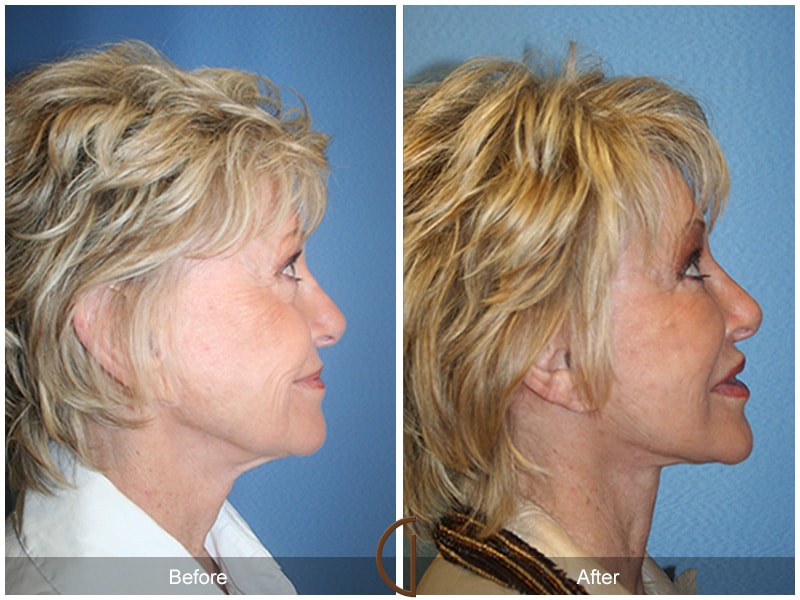 Facelift Woodcrest CA 34 Image