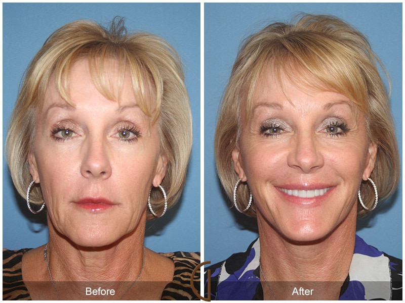 Facelift Orange County CA 35 Image