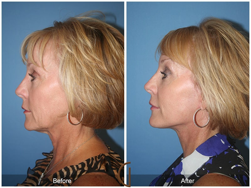 Facelift Orange County CA 35 Image