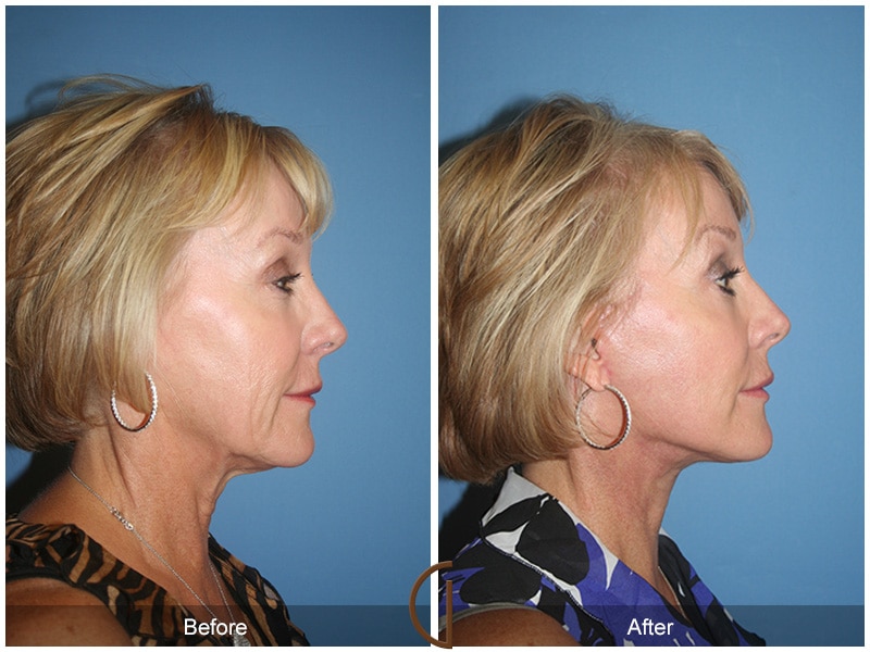 Facelift Orange County CA 35 Image