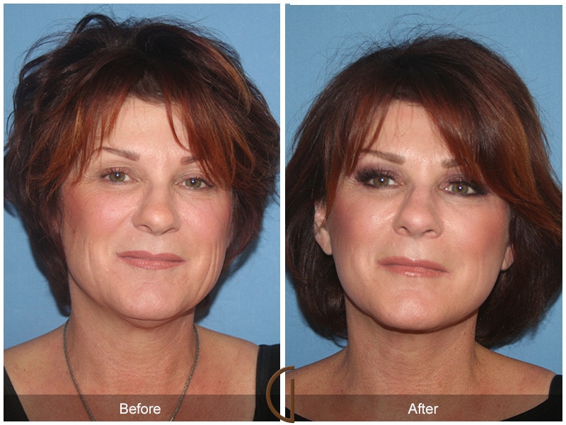 Facelift Norco CA Image