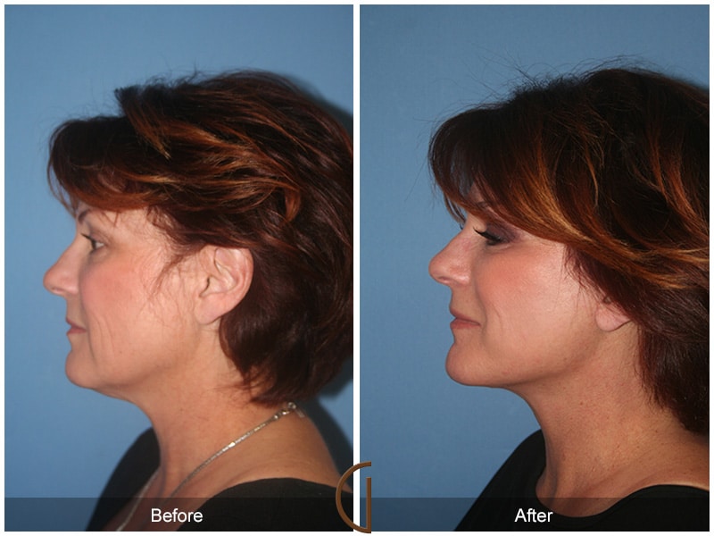 Facelift Norco CA Image