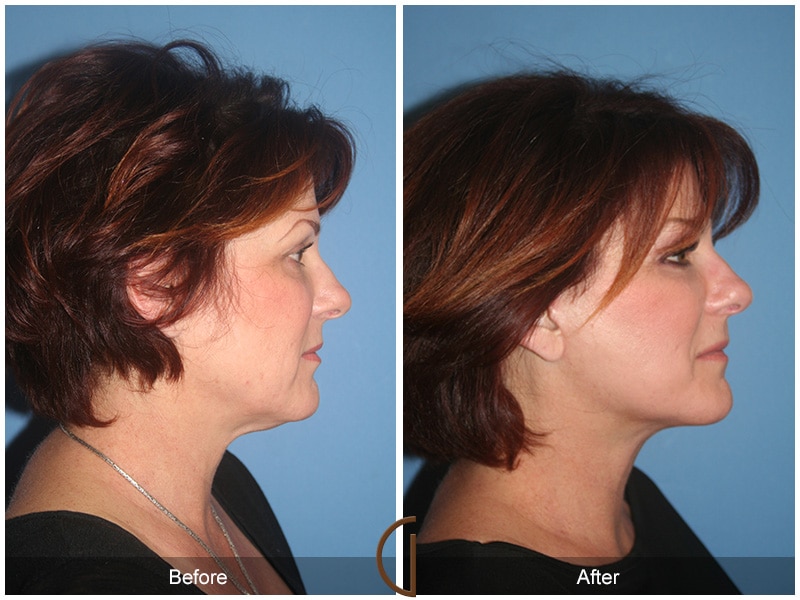 Facelift Norco CA Image