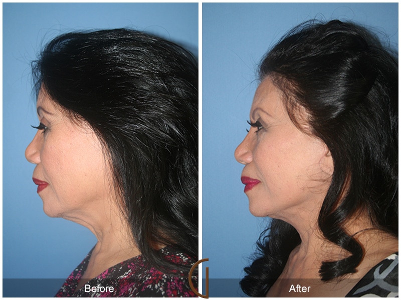 Facelift El Segundo CA 41 Image