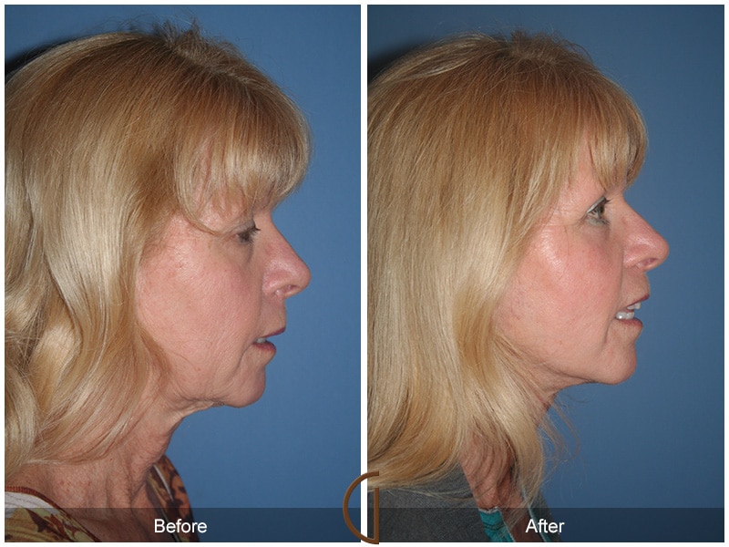 Facelift Altadena CA 42 Image