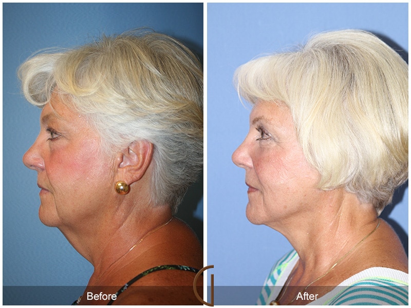 Facelift Coronado CA Image