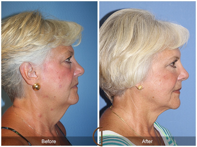 Facelift Coronado CA Image