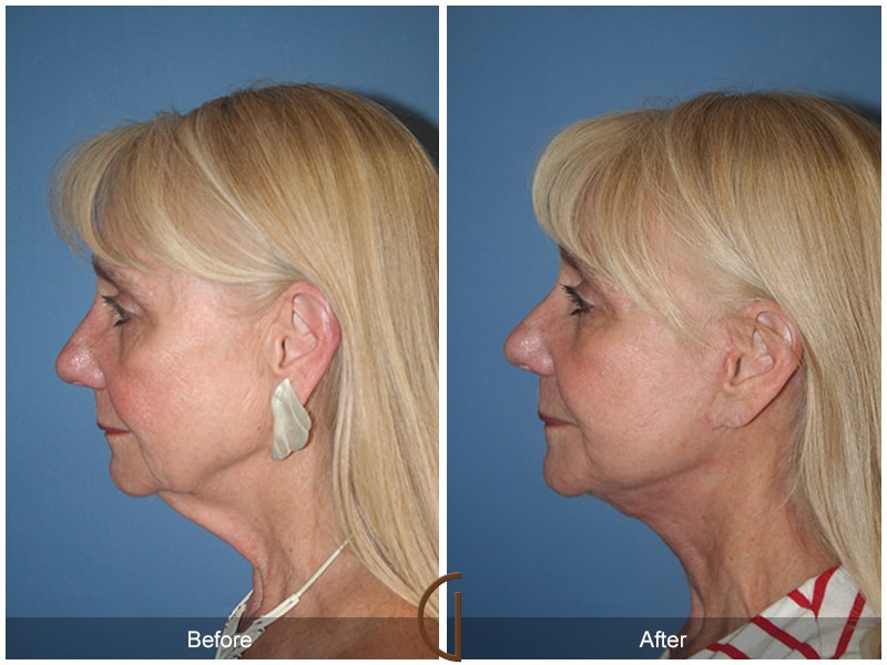 Facelift Arcadia CA 50 Image