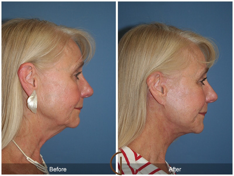 Facelift Arcadia CA 50 Image