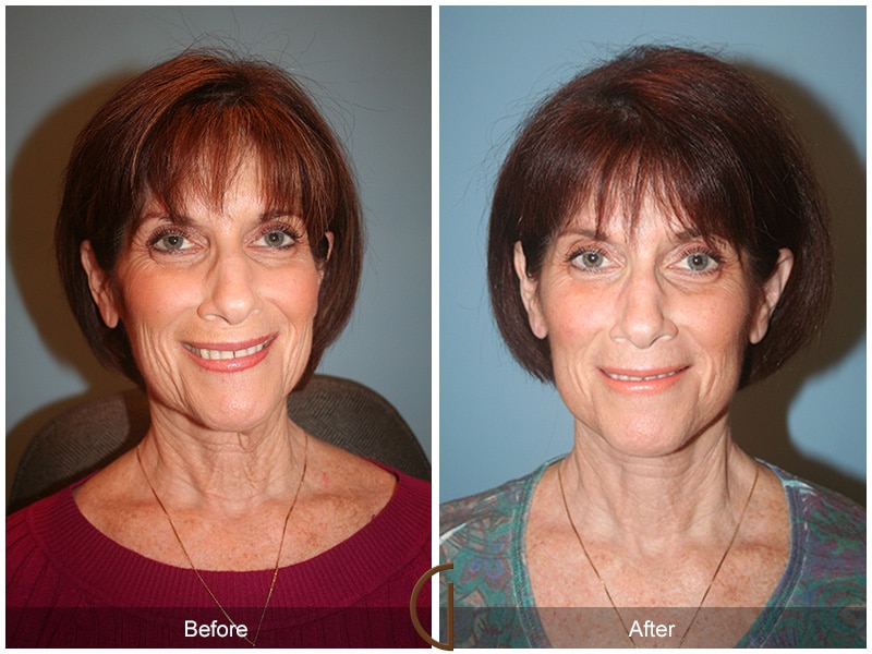 Facelift Temecula CA 57 Image