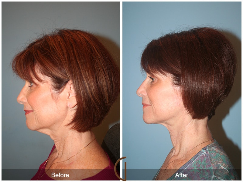 Facelift Temecula CA 57 Image