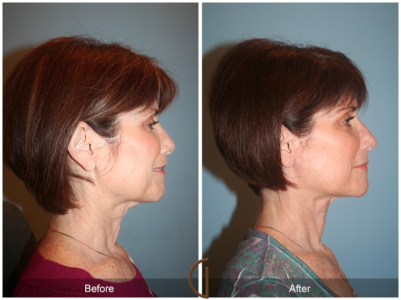 Facelift Temecula CA 57 Image