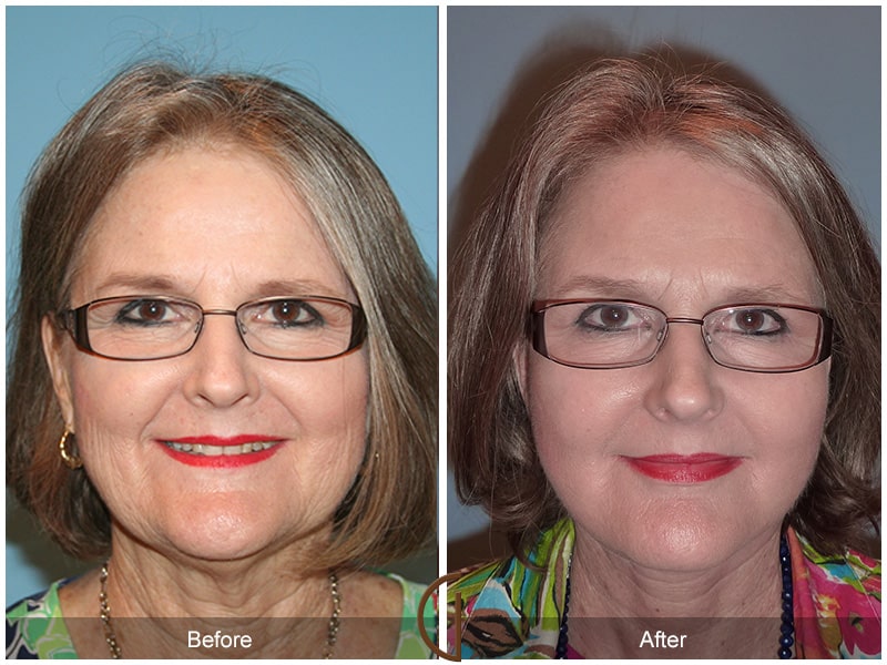 Facelift Torrance CA 6 Image