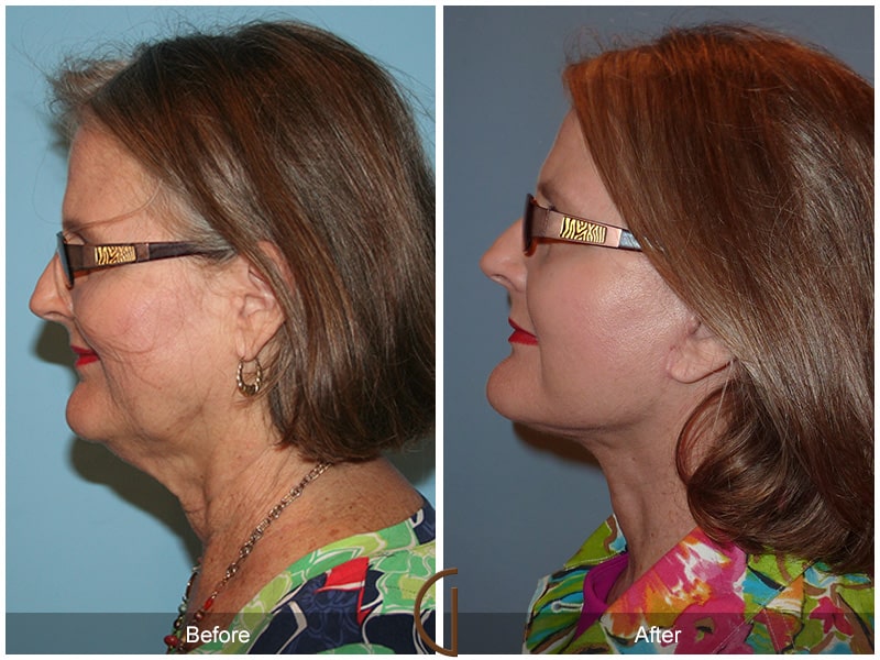 Facelift Torrance CA 6 Image