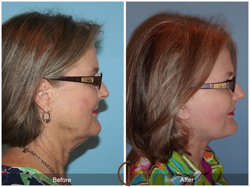 Facelift Torrance CA 6 Image