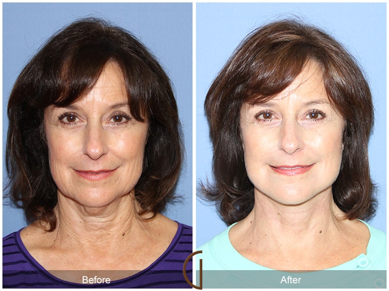 Facelift Santa Monica CA Image