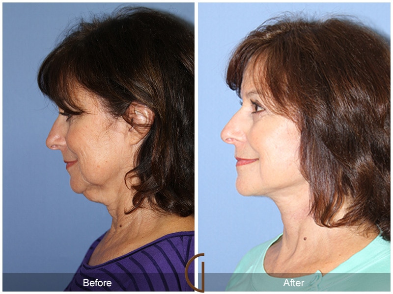 What is SMAS? Understand Your Facelift and Neck Lift Procedure Image