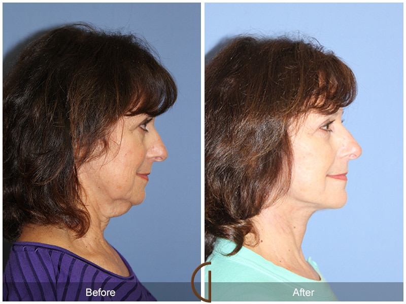 Facelift Santa Monica CA Image