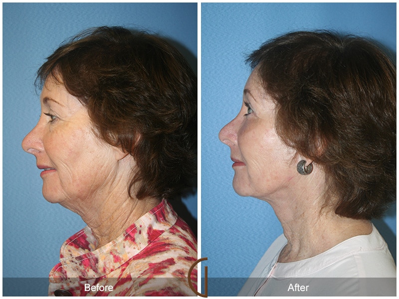 Facelift Hacienda Heights CA 67 Image