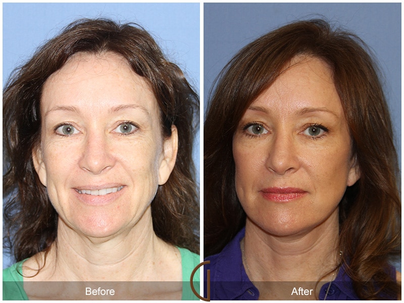 Facelift Pasadena CA Image
