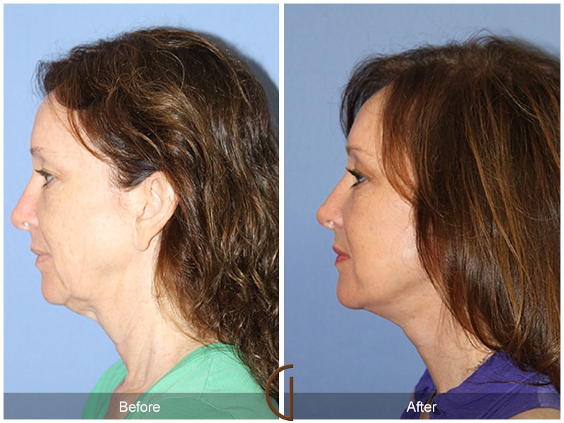 Facelift Pasadena CA Image