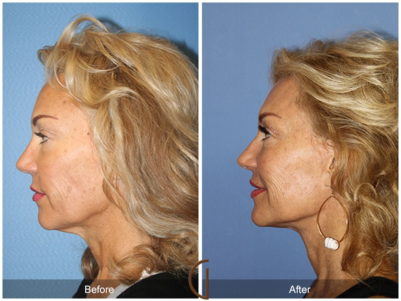 Facelift Hawaii Image