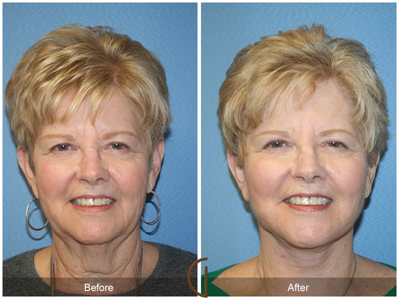 Facelift Orange County CA 7 Image