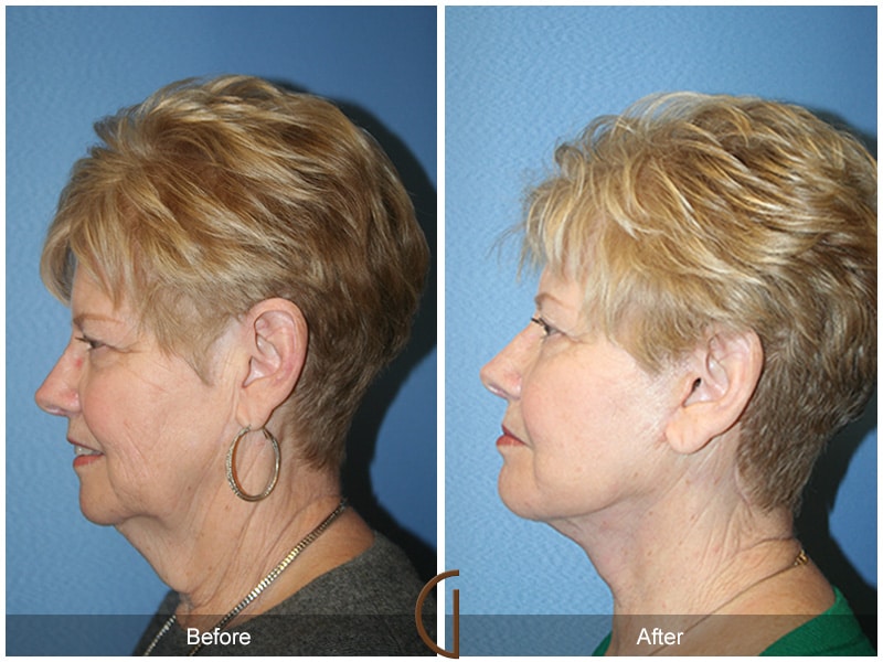 Facelift Orange County CA 7 Image