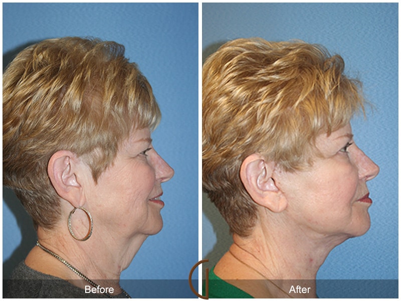 Facelift Orange County CA 7 Image