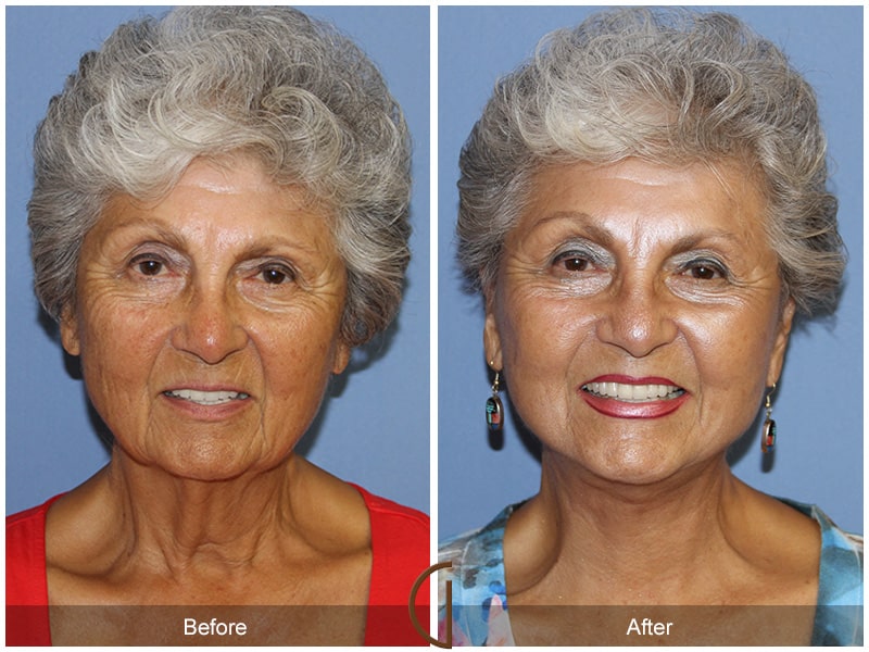 Facelift Santee CA 73 Image