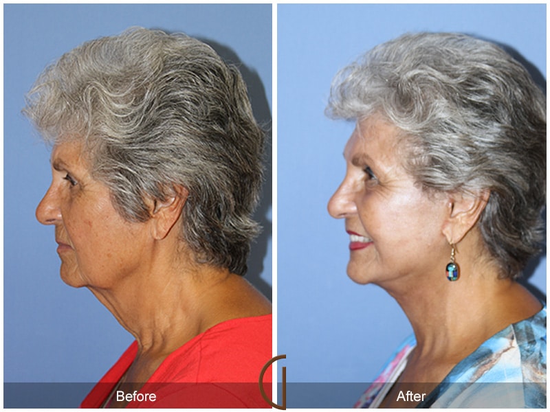 Facelift Santee CA 73 Image