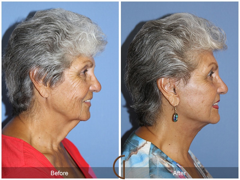 Facelift Santee CA 73 Image
