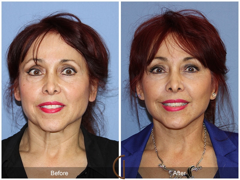 Facelift Glendora CA 74 Image