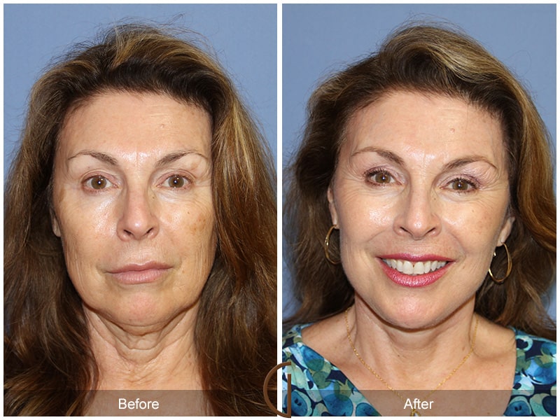 Facelift San Diego CA Image