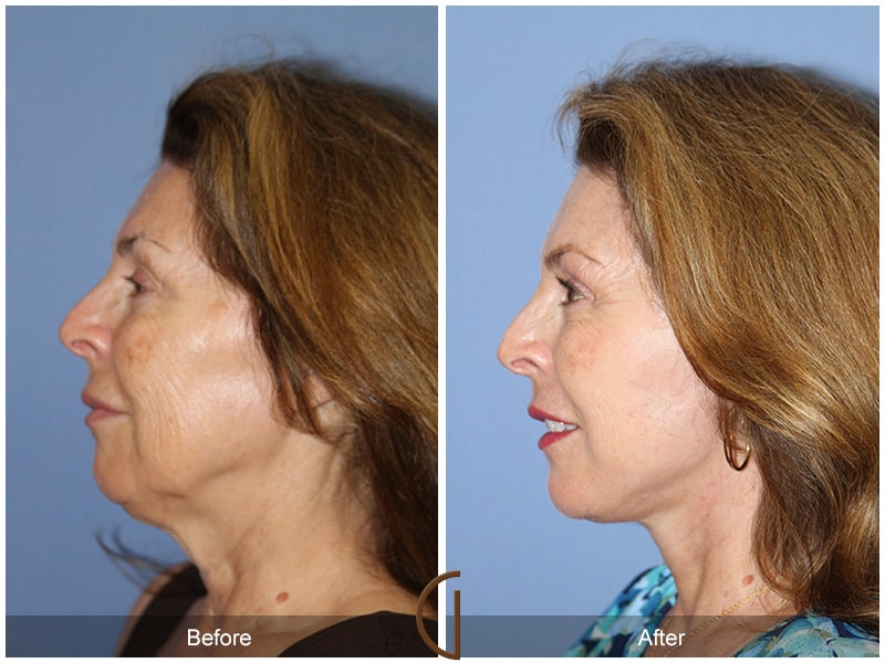 Facelift San Diego CA Image