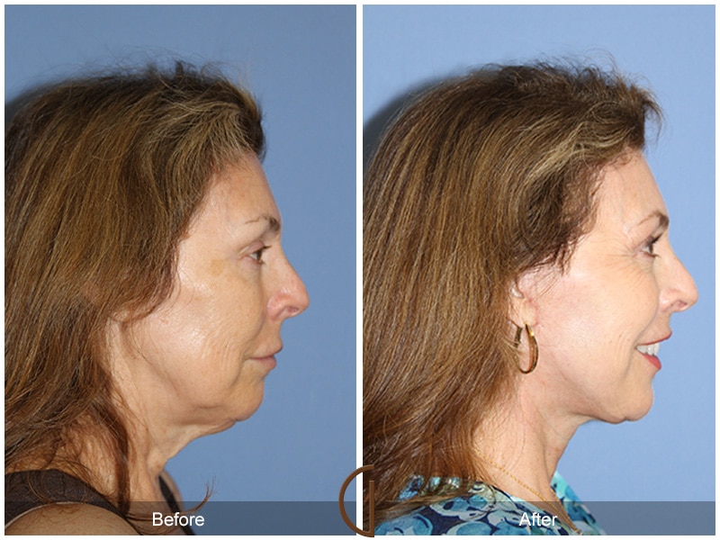 Facelift San Diego CA Image