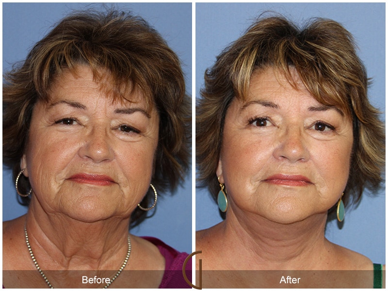 Facelift East San Gabriel CA 76 Image