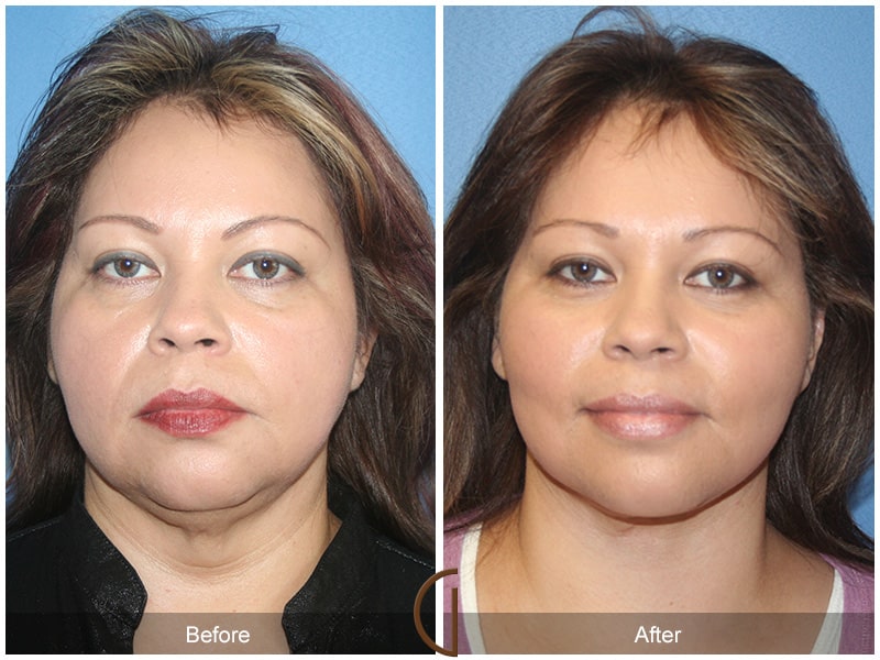 Facelift Avocado Heights CA 77 Image