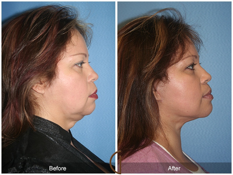 Facelift Avocado Heights CA 77 Image