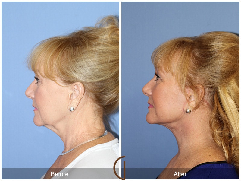 Facelift Los Angeles Image
