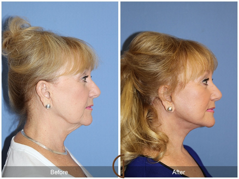 Facelift Los Angeles Image