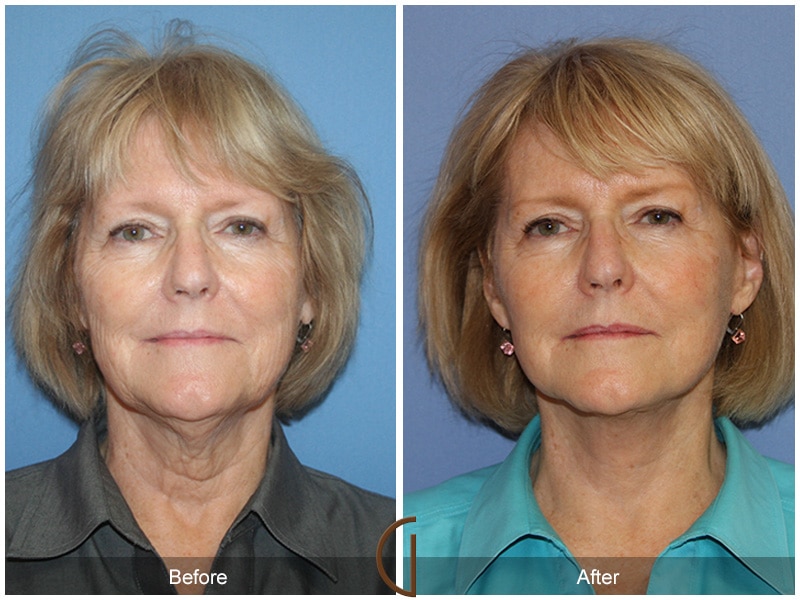 Facelift Palm Springs CA Image